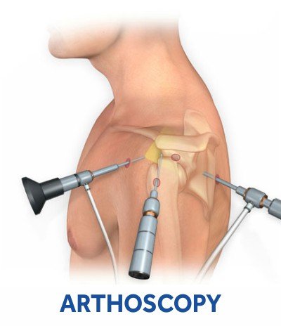 arthoscopy-hospital-surat