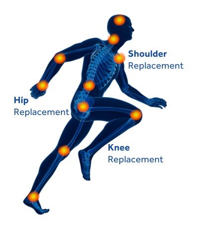 replacement-knee-hip-shoulder